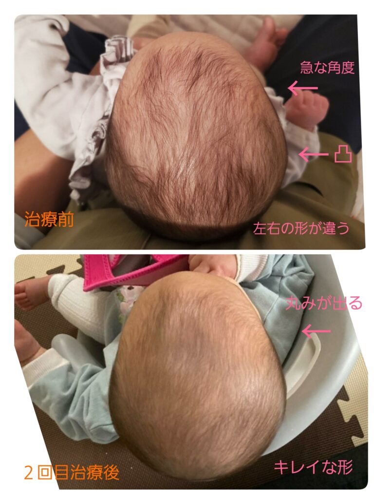 赤ちゃんの頭の形と目の大きさ 整えちゃえー 宝塚市の無双堂鍼灸整骨院