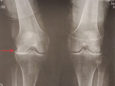 「変形性膝関節症」