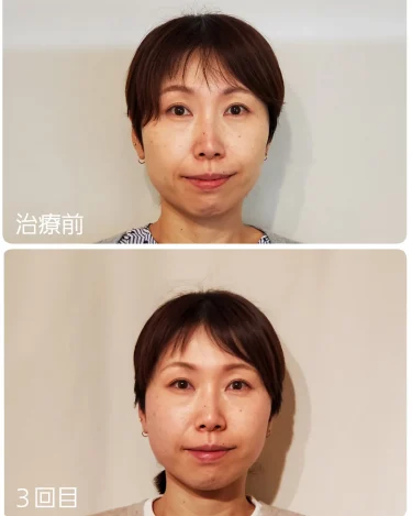 「顔バランス&小顔矯正」でコラーゲンが増える