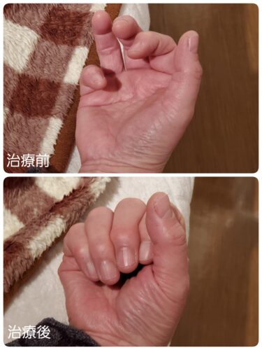 手術直前のバネ指